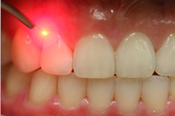 Laser-Dentistry