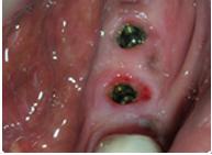 Multiple Teeth Implant