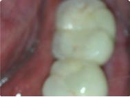 Multiple Teeth Implant