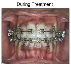 Metallic braces