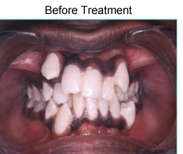 Metallic braces