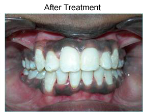 Metallic braces