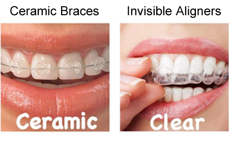 aligners