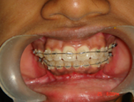 Ceramic braces