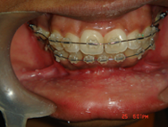 Ceramic braces
