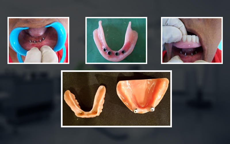 overdenture