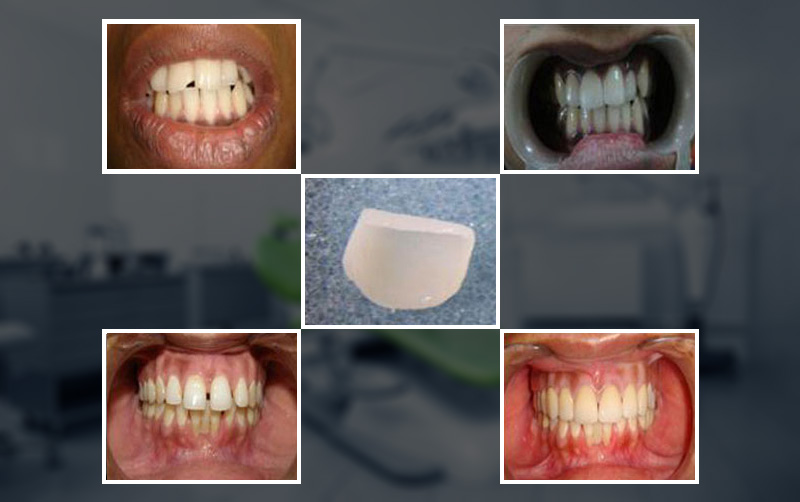 laminates & veneers