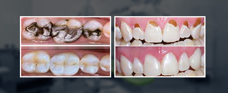 Colored Fillings