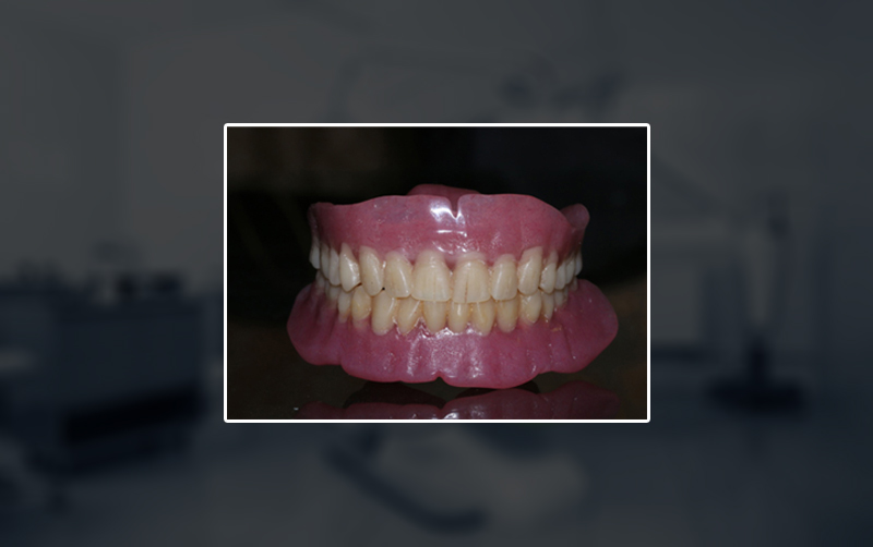 Partial Dentures
