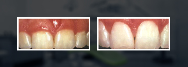 crown lengthening