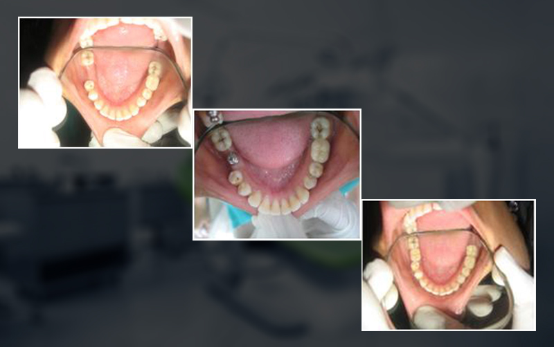 Single Tooth Implant