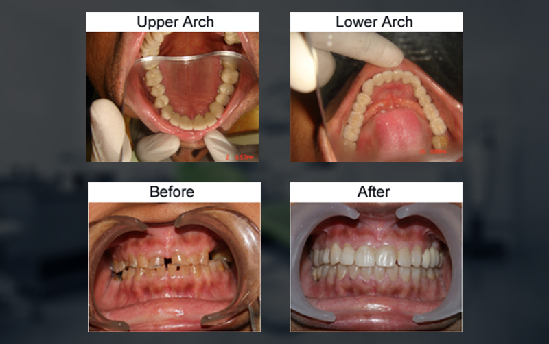 Full Mouth Reconstruction