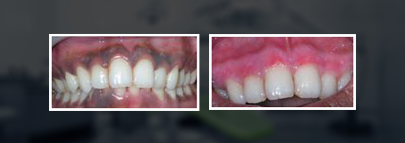 gum depigmentation