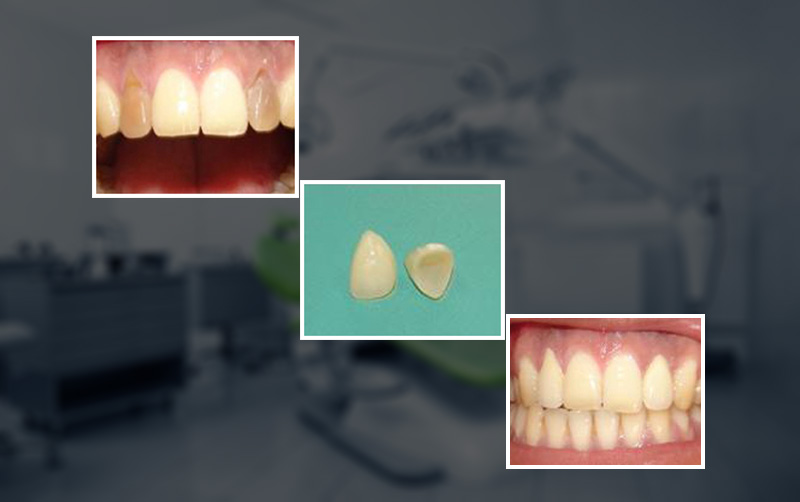 ceramic crowns