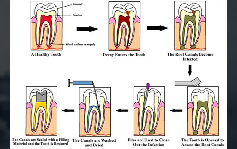 Root Canal