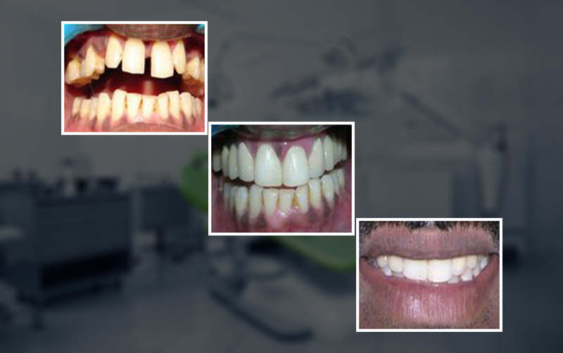 smile makeover