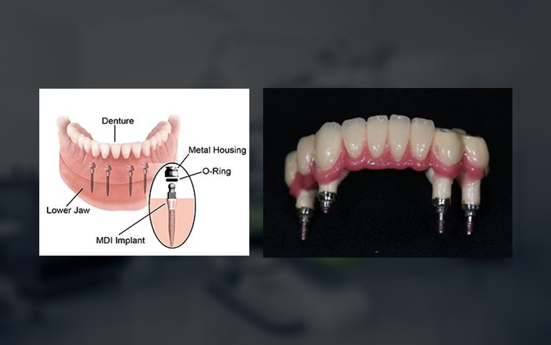 Supported Dentures