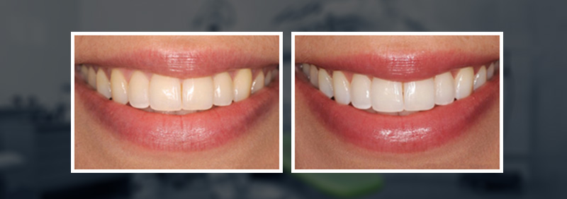 whitening