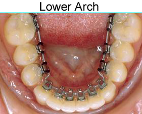 invisible braces