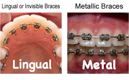 aligners