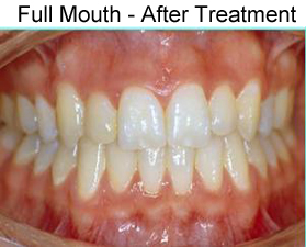 invisible braces