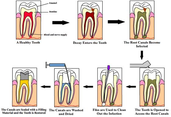 root canel treatment